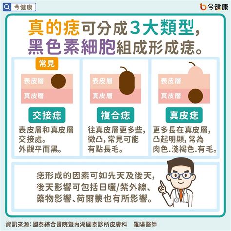 痣是凸的|是痣or皮膚癌？醫「1張圖秒對照」 長這2部位最危險